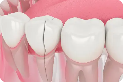 Plaisājis zobs ar redzamu vertikālu plaisu un apsārtušām smaganām pie zoba pamatnes