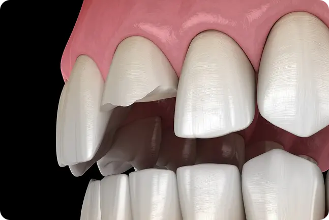 Tuvplānā stipri salauzts augšējais priekšējais zobs ar lielu nolūzumu