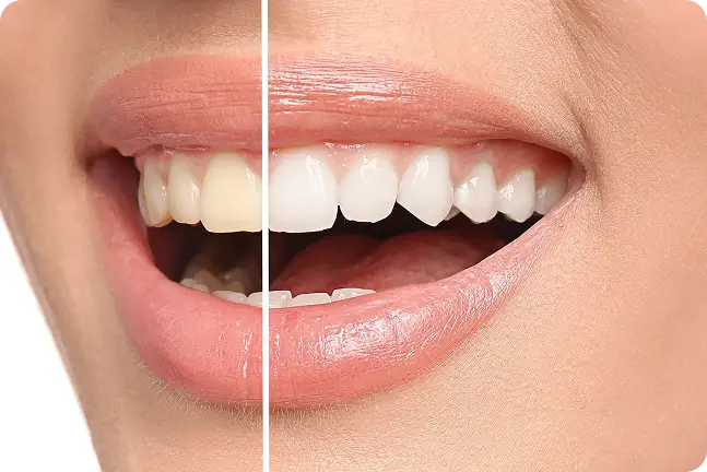 Tuvplāna smaids kas parāda zobu toņa izmaiņas pirms un pēc estētiskas procedūras