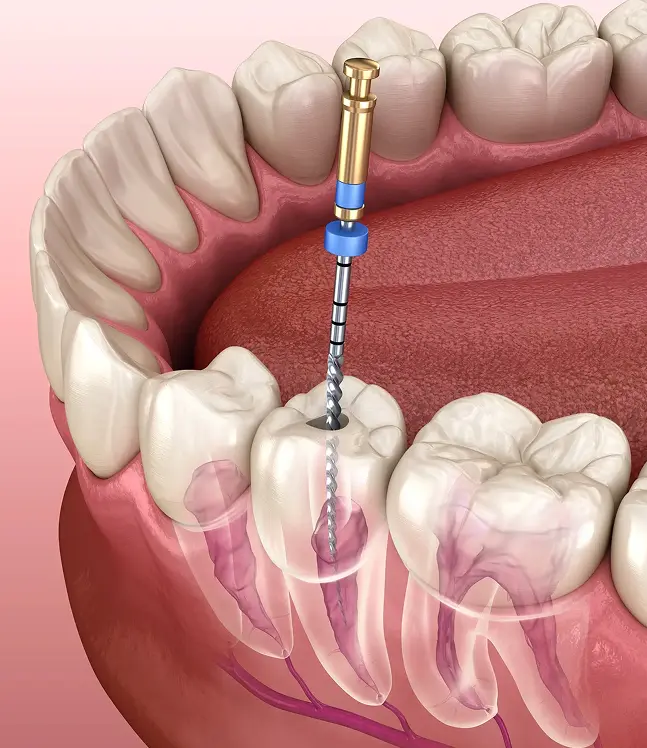 Zoba sakņu kanālu ārstēšana, kur endodontijas faile tīra molāra kanālu zoba iekšpusē