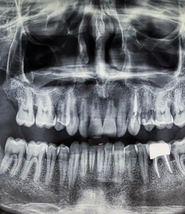 Ortopantomogrāfija pieaugušam pacientam, digitāls panorāmas zobu rentgens ar visu žokli un zobu saknēm