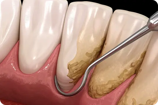 Zobakmens noņemšana pie smaganām ar zobārstniecības instrumentu