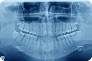 panorāmas zobu rentgens ar visu žokli un zobu saknēm