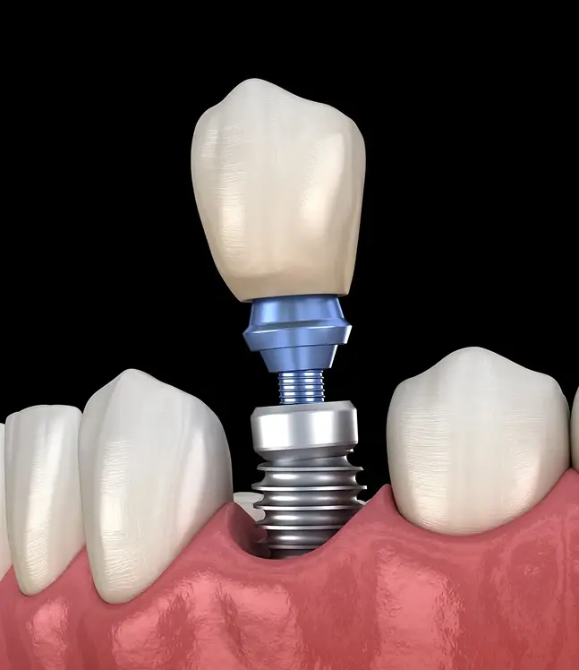 zobu implants smaganā ar abatmentu un kroni starp blakus zobiem
