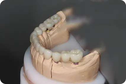 Vairāku zobu aizvietošana ar implantu uz modeļa, demonstrējot zobu rindas atjaunošanu