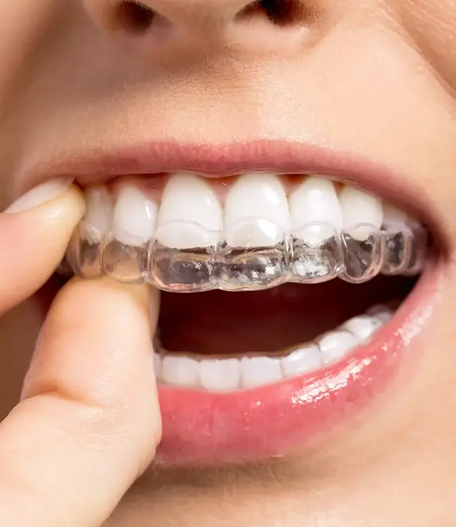 Kapes zobu taisnošanai uzlikšana ar pirkstiem, redzami balti zobi un smaids