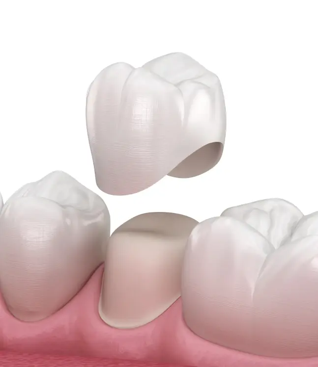 Zobu kronis tiek uzstādīts uz sagatavota zoba, blakus pārējie zobi un smaganas