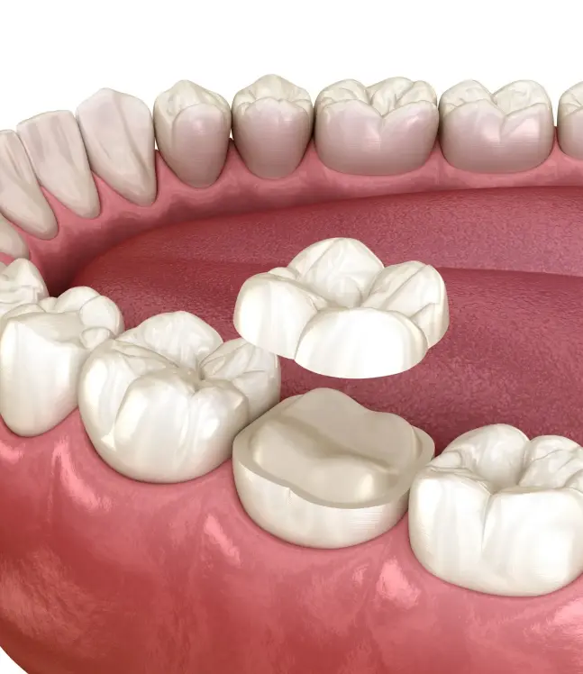 Onlay ieliknis dzeroklim, blakus redzams sagatavots zobs un ieliknis ko uzliek virsū zobam