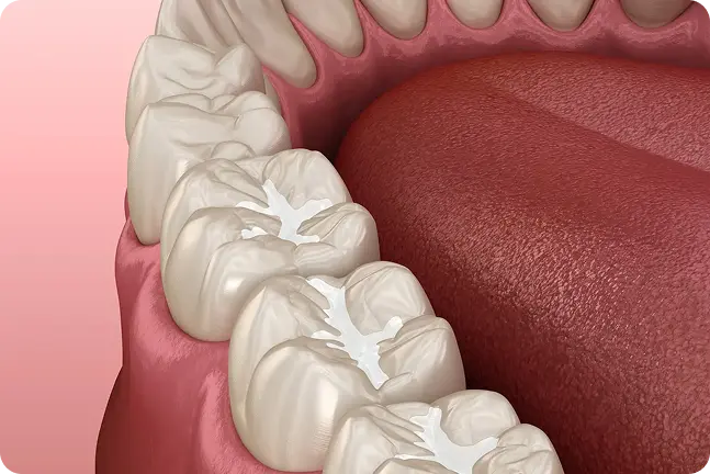 Dzerokļu rieviņās uzklāti silanti, materiāls aizpilda zoba virsmu plaisas