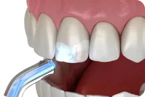 Zoba plombēšana, polimerizācijas lampa sacietina plombes materiālu uz priekšzoba