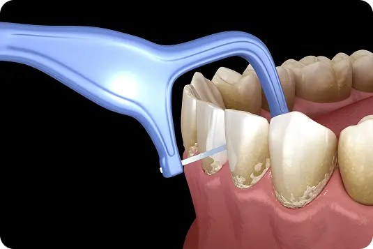 Zobu diegs starpzobu tīrīšanai noņem aplikumu un palīdz novērst kariesu un smaganu iekaisumu