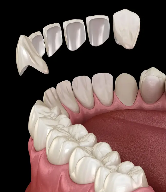 Estētiska zobu restaurācija ar venīriem, redzamas atsevišķas plāksnītes uz melna fona