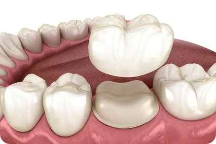 Zobu protēzēšana ar kroni, kronis virs sagatavota dzerokļa pirms uzlikšanas