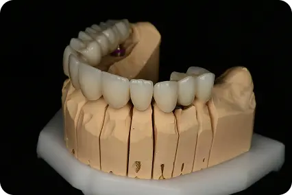 Priekšzobu tilts protēzēšanai uz laboratorijas modeļa, vienmērīga forma un tonis