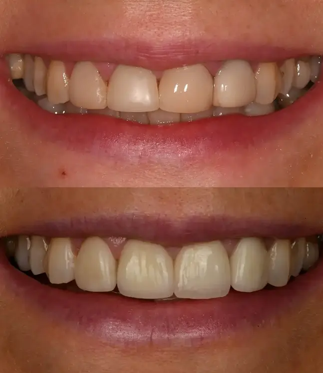 Smaids pirms un pēc zobu protezēšanas ar keramikas kroņiem, zobu formas un toņa uzlabojums