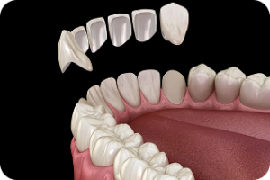 Porcelāna zobu venīri dažādos izmēros un venīru uzlikšanas process uz priekšējiem zobiem