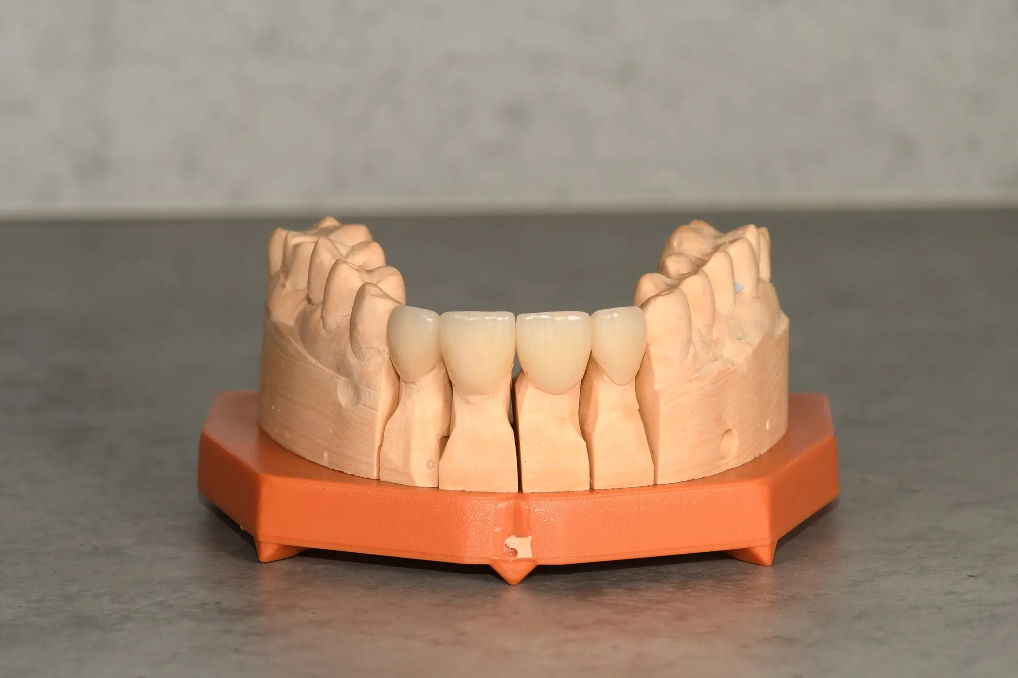 Zobu modelis ar uzliktiem porcelāna venīriem priekšzobiem demonstrējot plāksnīšu formu un pielāgošanu