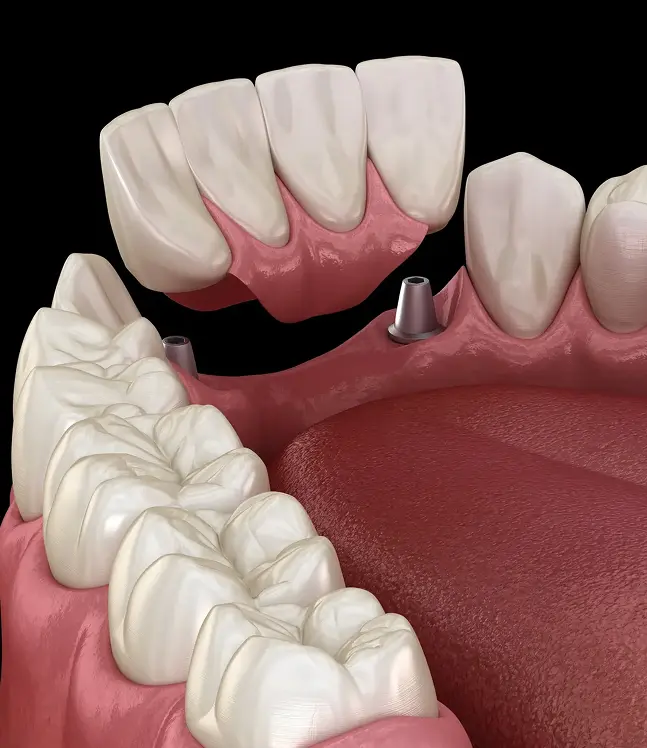 Priekšzobu tilts tiek uzlikts uz implantu balstiem virs smaganām