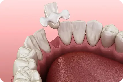 Maryland adhezīvais zobu tilts tiek pozicionēts priekšzoba aizvietošanai