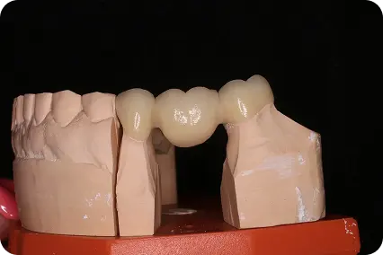 Zobu tilts uz sagatavota ģipša modeļa, demonstrējot precīzu atbilstību sāna zobiem