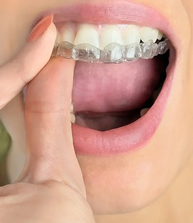 caurspīdīga zobu aizsargkape tiek uzlikta uz augšējās zobu rindas