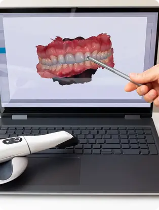Intraorālais skeneris blakus klēpjdatoram, ekrānā redzams 3D zobu un smaganu modelis