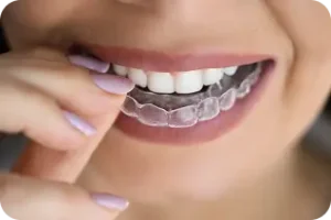 Sieviete ar pirkstiem uzliek caurspīdīgu zobu aizsargkapi uz augšžokļa zobiem