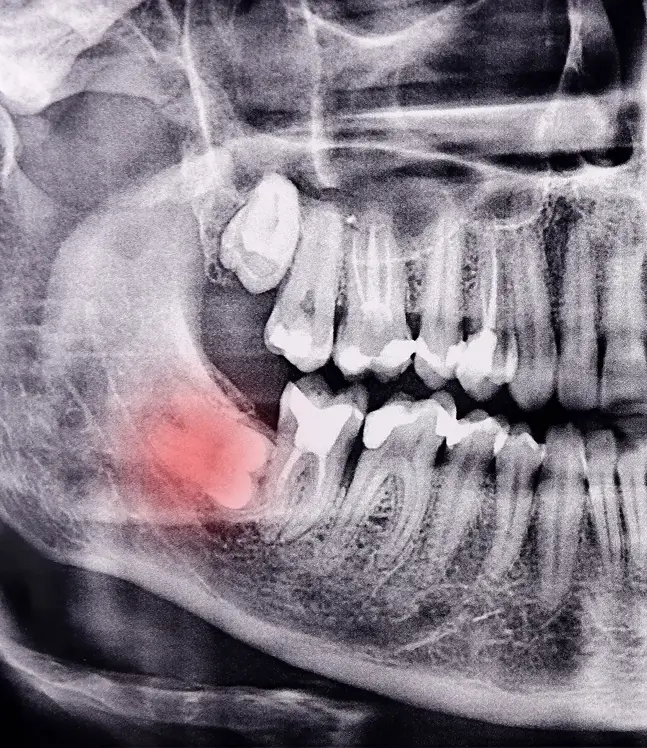 Panorāmas zobu rentgens apakšējais gudrības zobs guļus stāvoklī