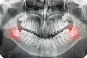 Zobu panorāmas rentgens ar nepareizu apakšējo gudrības zobu augšanu un izceltām vietām